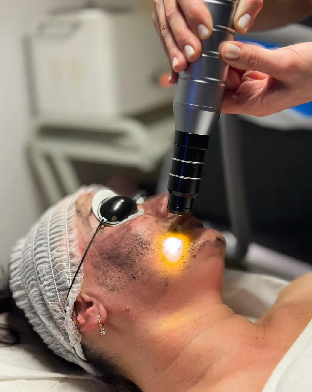 Is a Laser Carbon Peel Painful