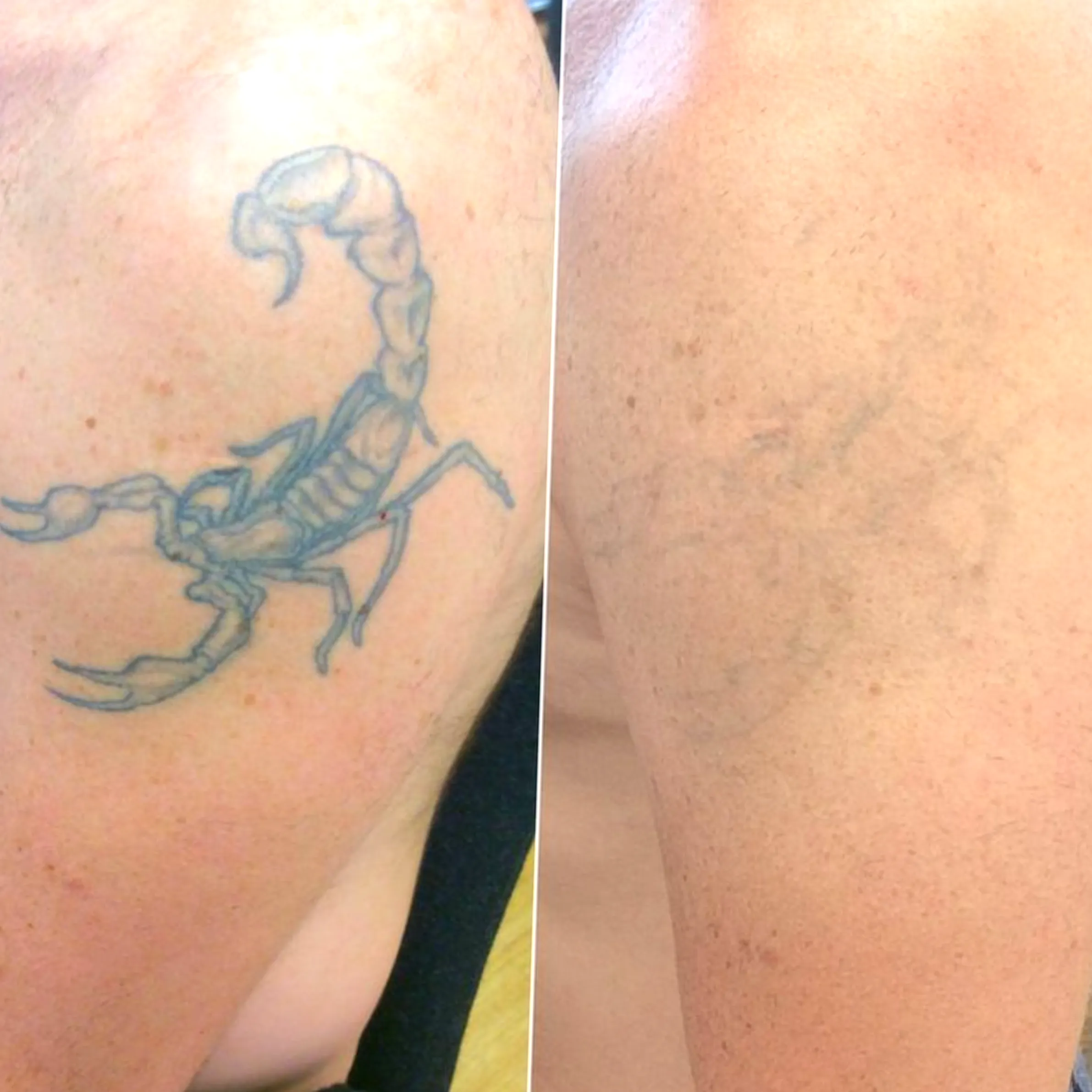 laser tattoo removal Melbourne