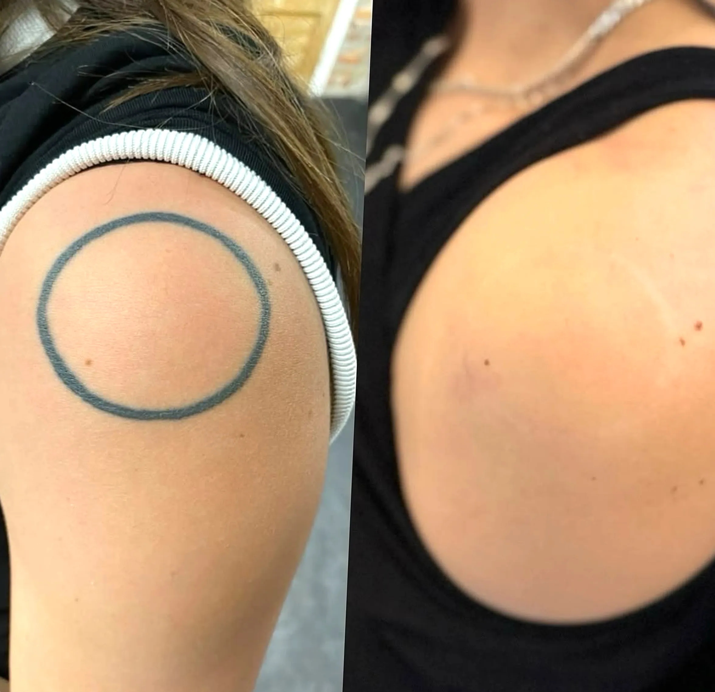 cosmetic tattoo removal cost