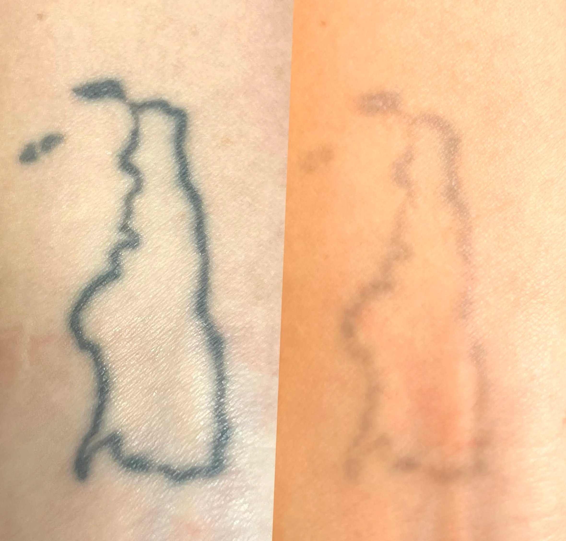 tattoo removal insurance claim