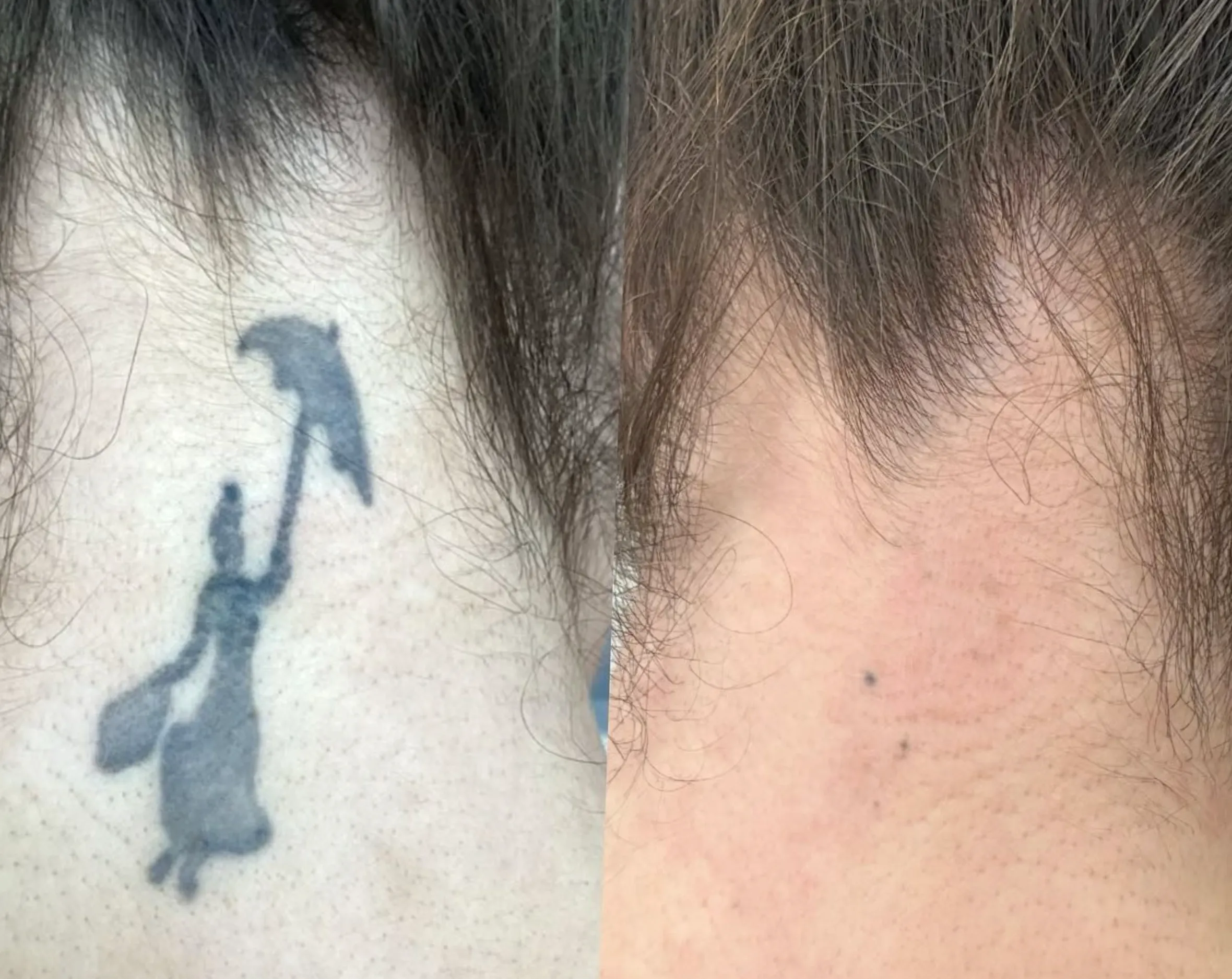 medically necessary tattoo removal