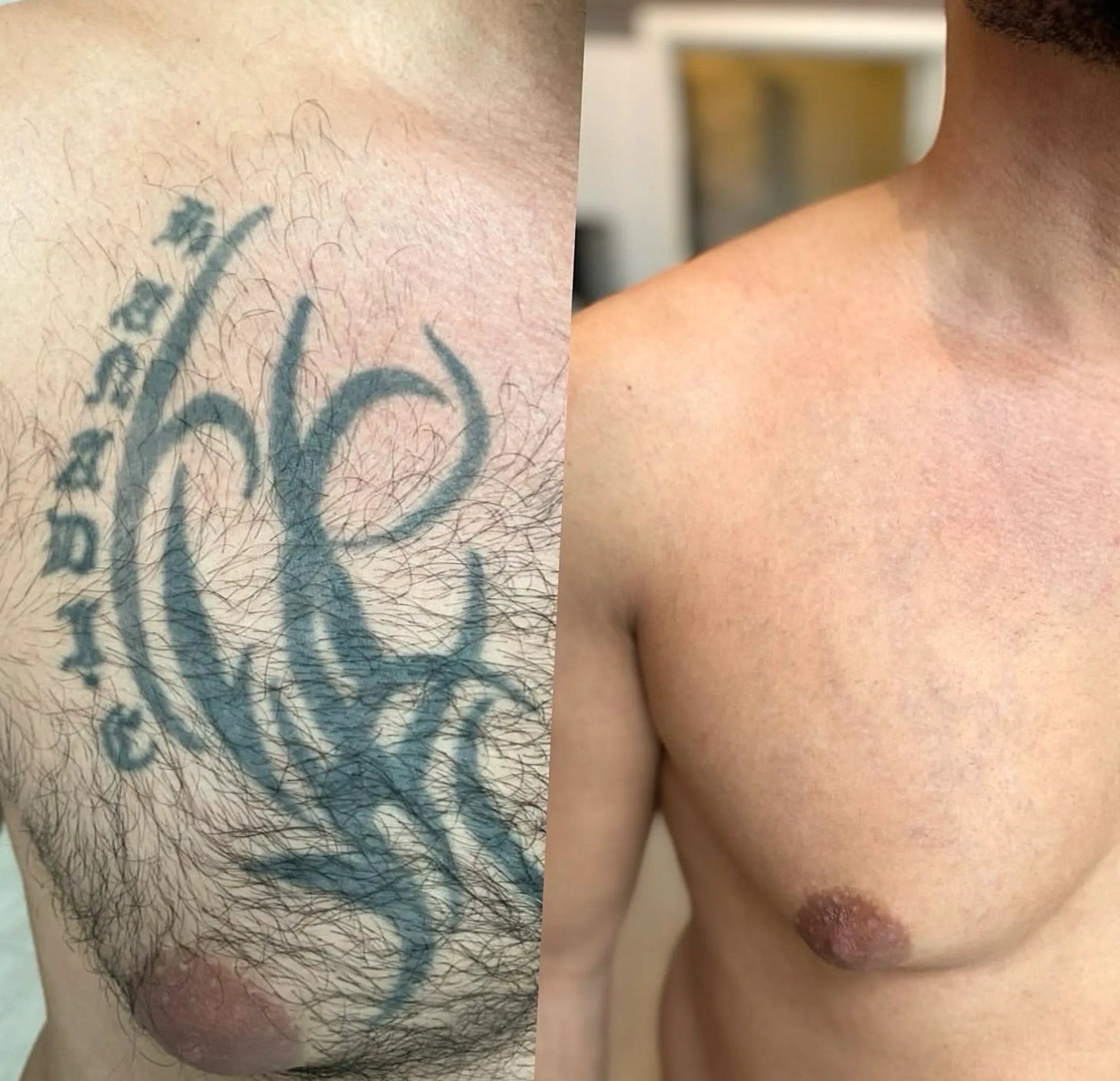 tattoo removal Medicare Australia