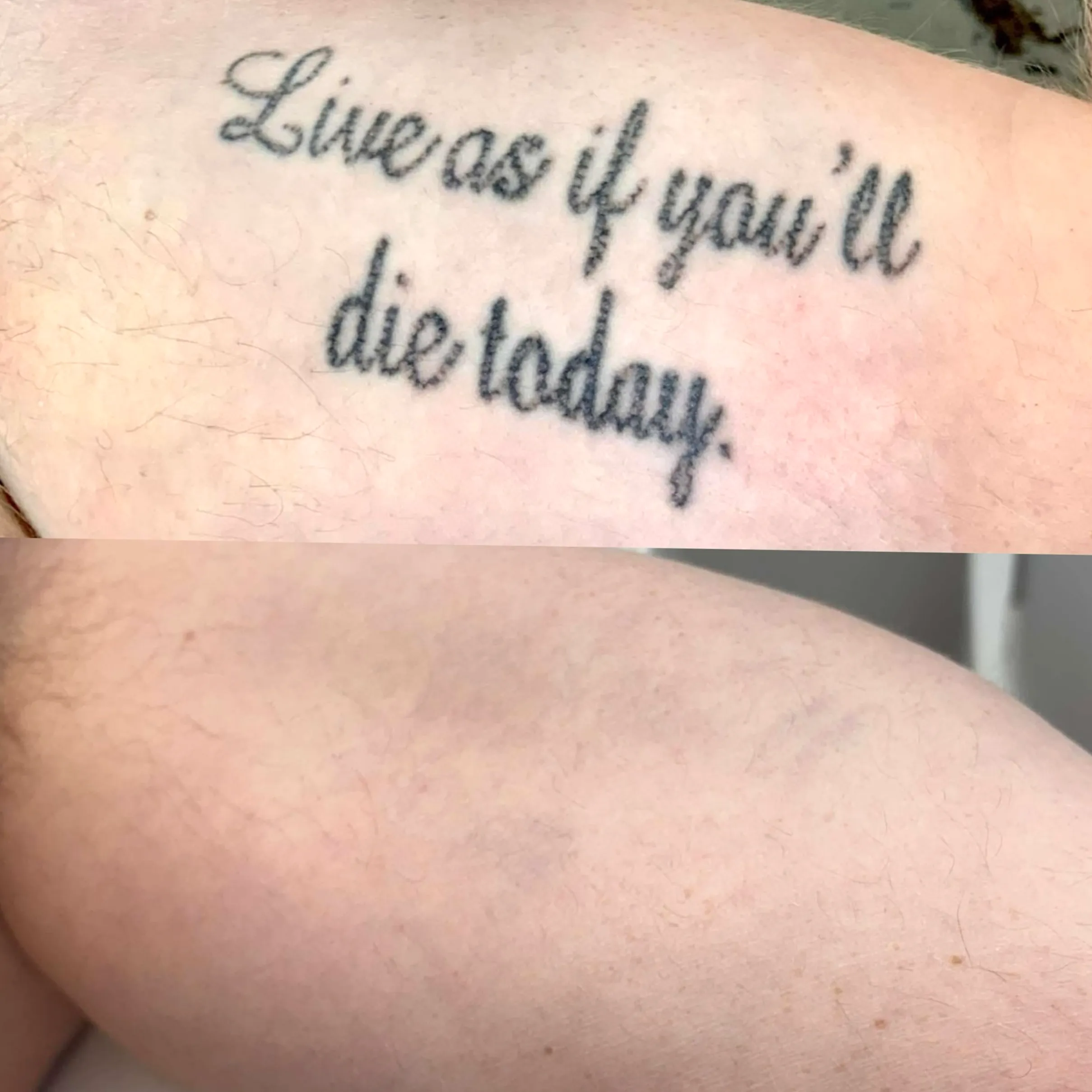 does health insurance cover tattoo removal
